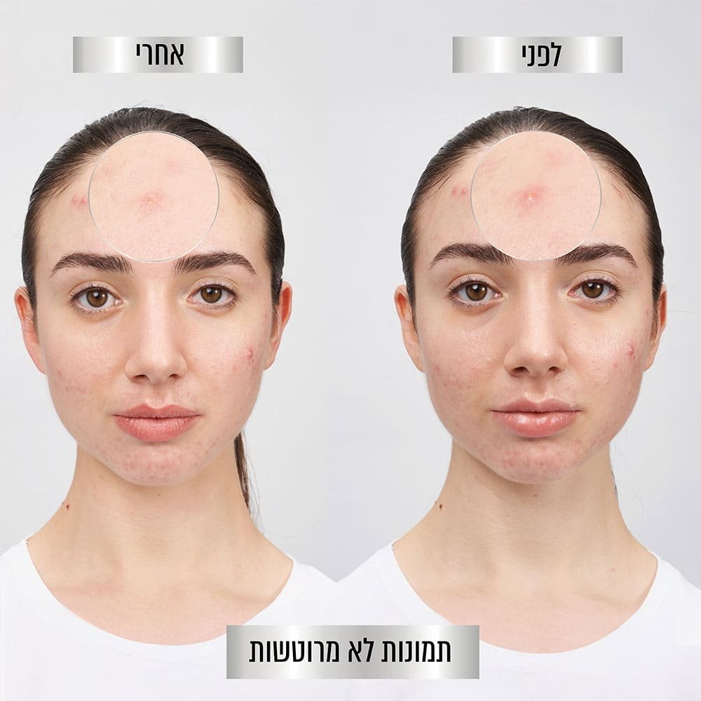בחורה מציגה מראה פצעונים בפנים לפני ואחרי שימוש במדבקות. תמונות לא מרוטשות.