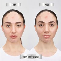 בחורה מציגה מראה פצעונים בפנים לפני ואחרי שימוש במדבקות. תמונות לא מרוטשות.