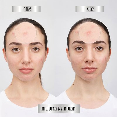 בחורה מציגה מראה פצעונים בפנים לפני ואחרי שימוש במדבקות. תמונות לא מרוטשות.