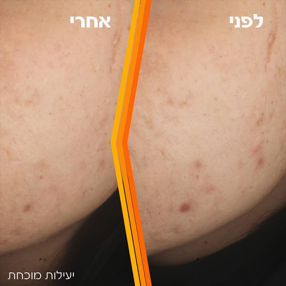 תצוגת עור הפנים לפני ואחרי השימוש בסרום ויטמין C